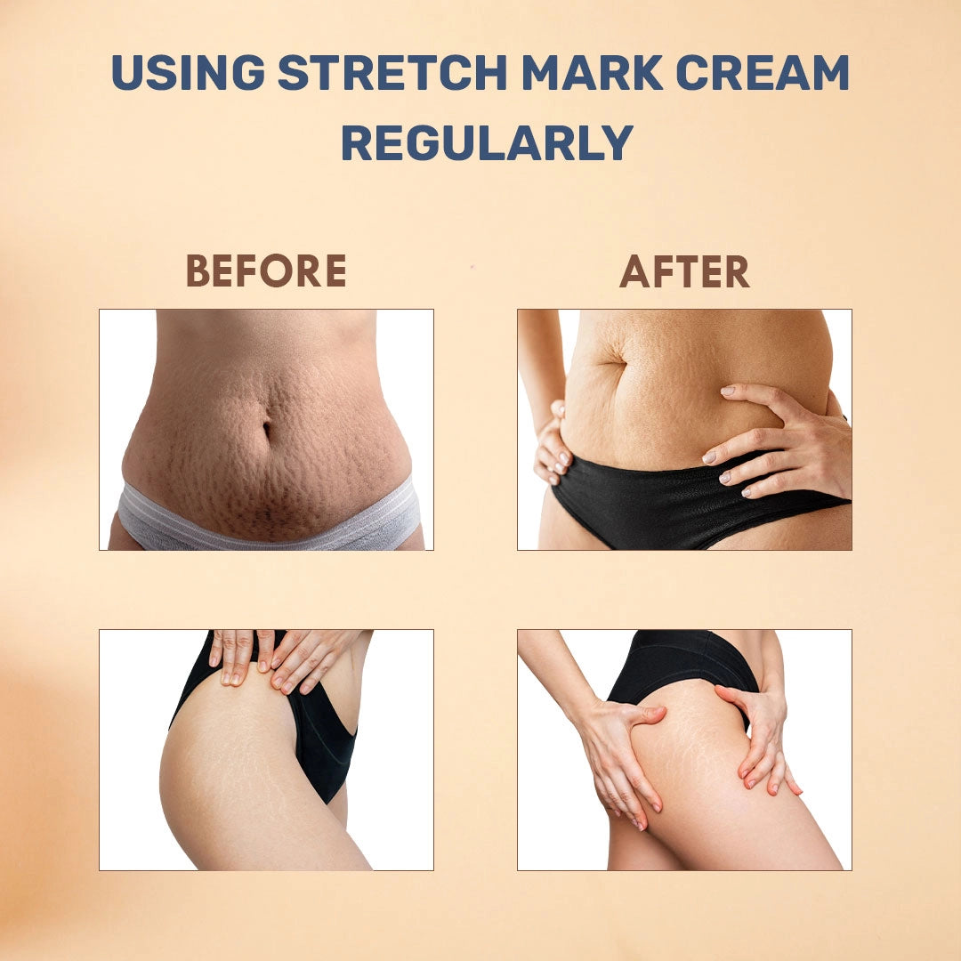 Veda Harvest Natural Stretch Mark Cream for Women & Men