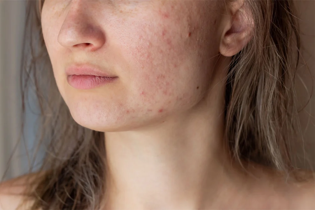 acne-skin