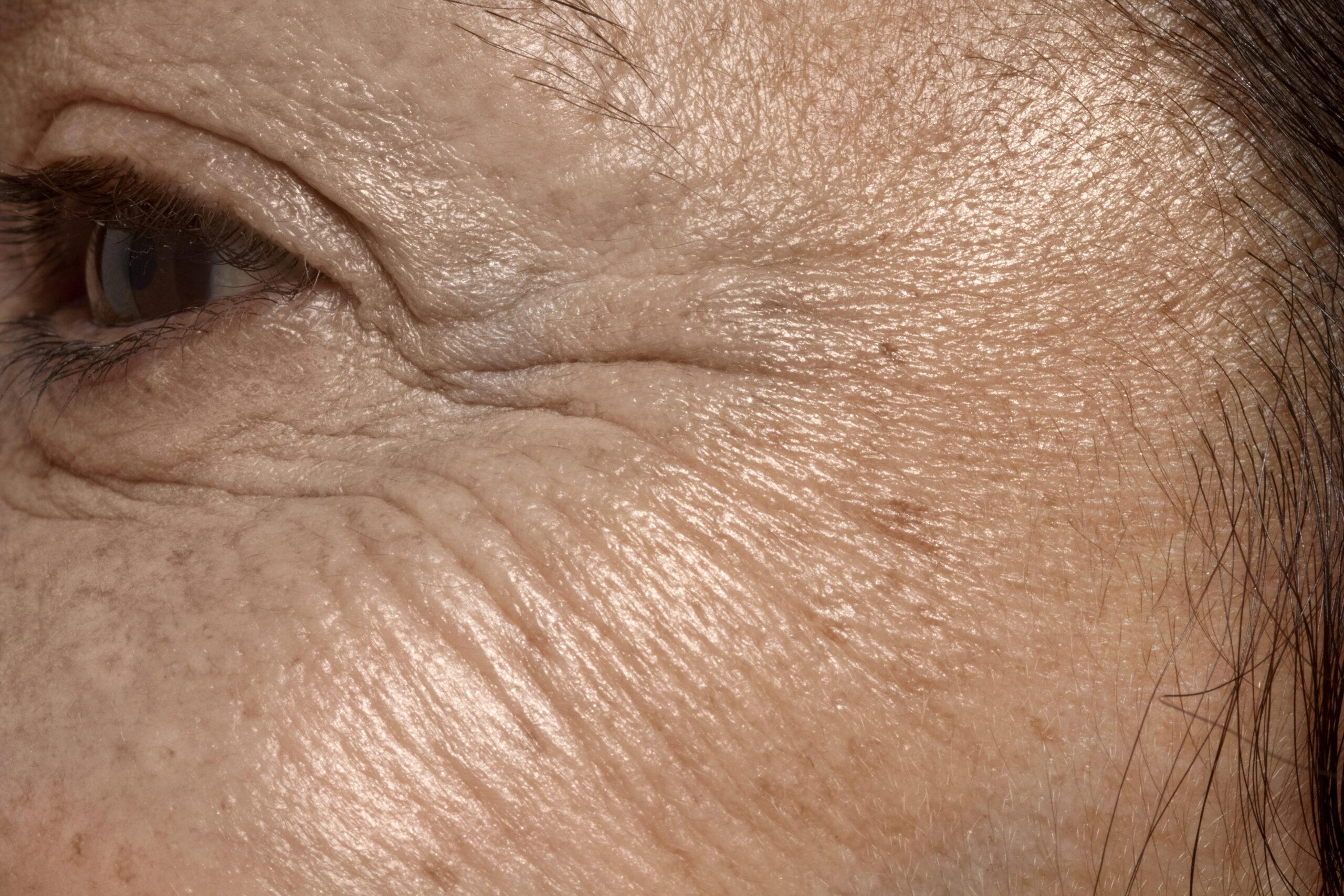 fine lines and wrinkles