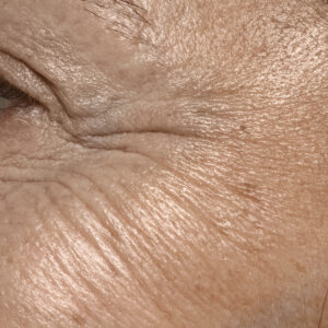 Fine Lines And Wrinkles